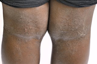 Poza de eczemă pe partea din spate a genunchilor