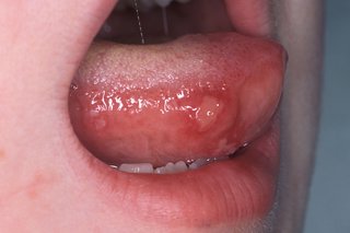 Ulcerul bucal pe limba copilului mic.