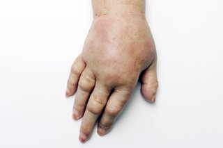 Pielea întinsă pe mână și braț cauzată de edem