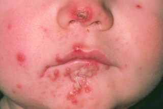 Impetigo scrima pe chipul unui copil mic