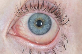 Un ochi roșu și apos cauzat de conjunctivită