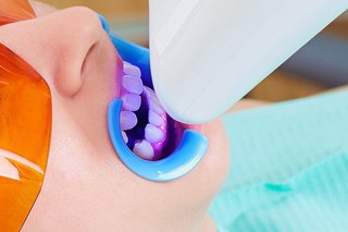 Albirea dentară