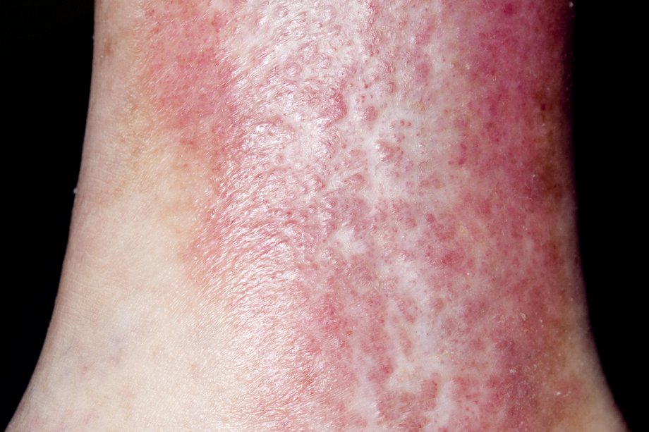 Deteriorarea pielii piciorului în varicoză
