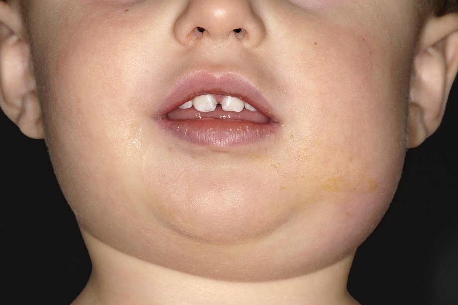 Un copil cu fața umflată cauzată de oreion.