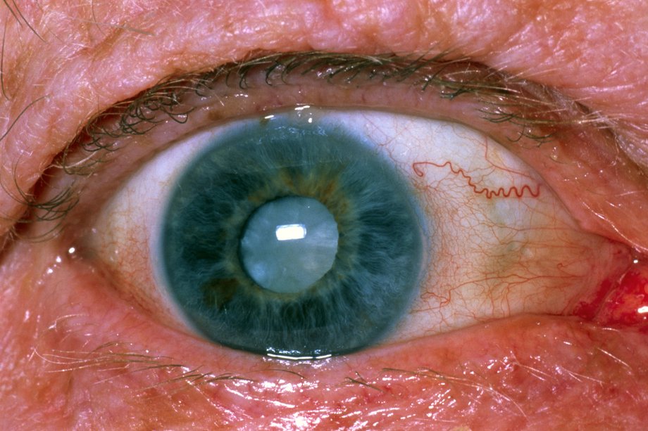 Un ochi cu cataractă
