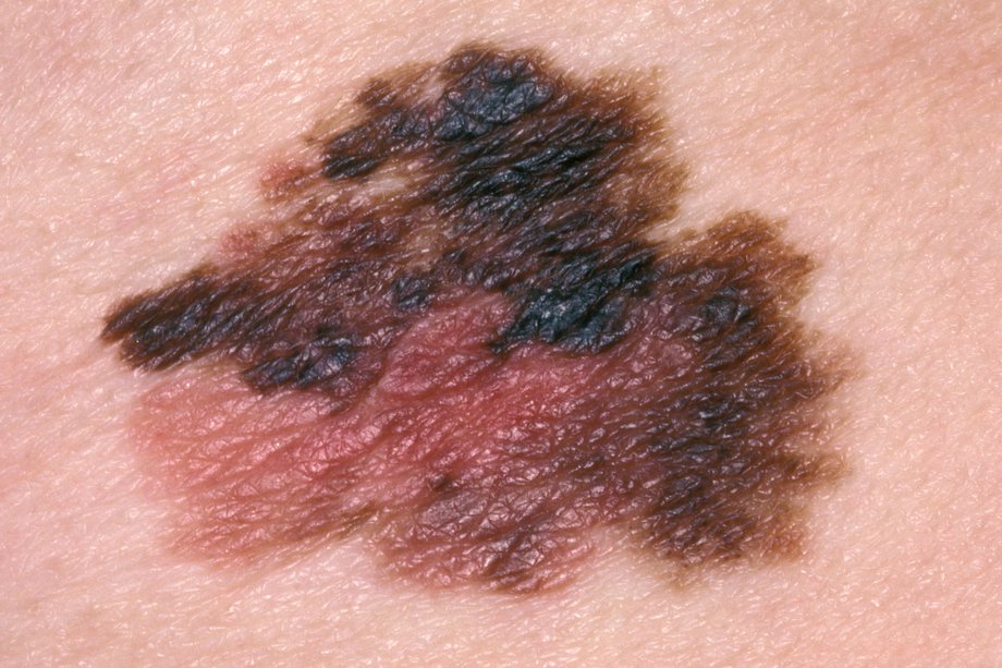 Imagine a melanomului răspândit superficial.