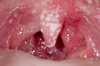 Patch-uri albe în interiorul gurii cauzate de epuizare orală