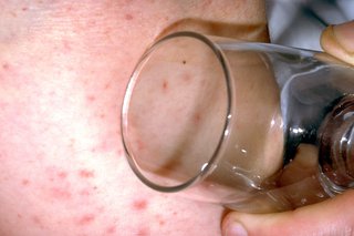 Imagine cu erupții cu meningită pe pielea albă cu sticlă ținută împotriva ei