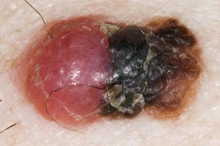 Un exemplu de melanom cu mai multe culori