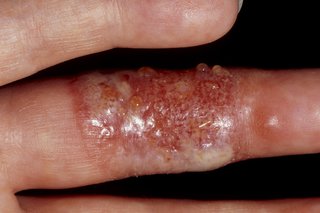 Blistere pe deget cauzate de virusul herpes