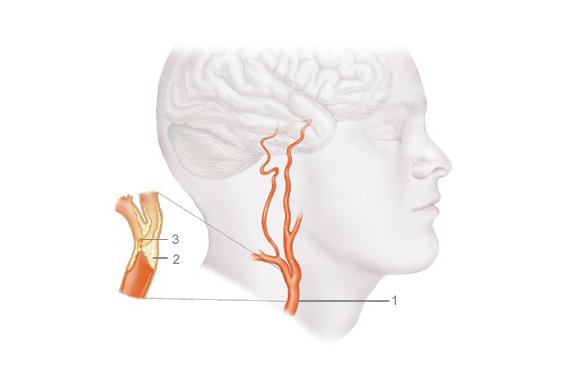 Poza unei artere carotide blocate