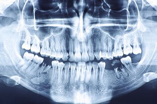 Boala gingiilor vă poate crește riscul de probleme de sănătate în alte zone ale corpului