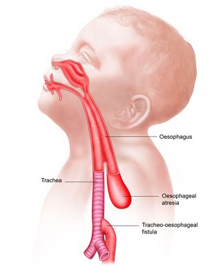 Diagrama care prezintă atrezie esofagiană și fistula traheo-esofagiană