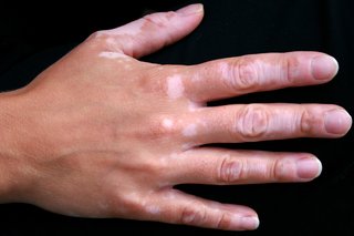 O mână cu pete de vitiligo de piele palidă pe degete și spatele mâinii
