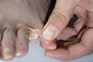 Patch alb între degetele cauzate de piciorul de atlet