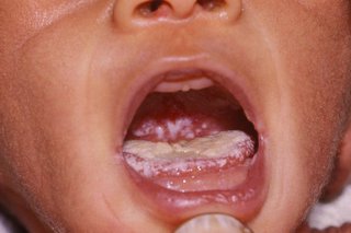 Acoperire albă pe limba copilului