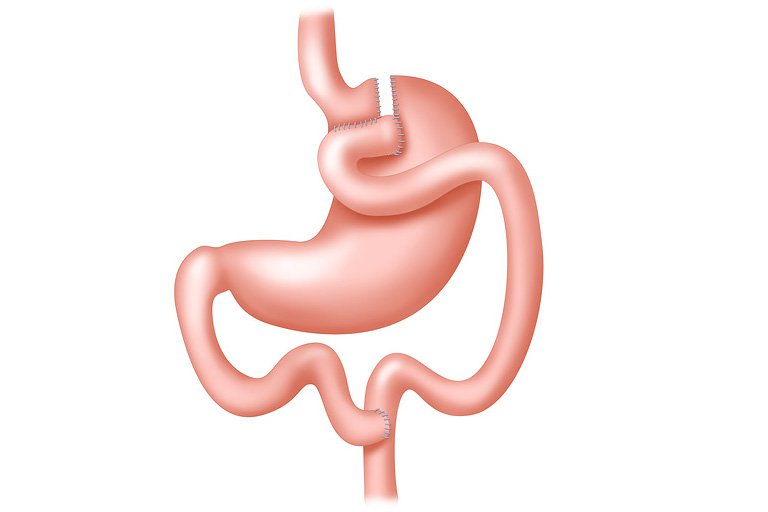 O ilustrare a unui bypass gastric